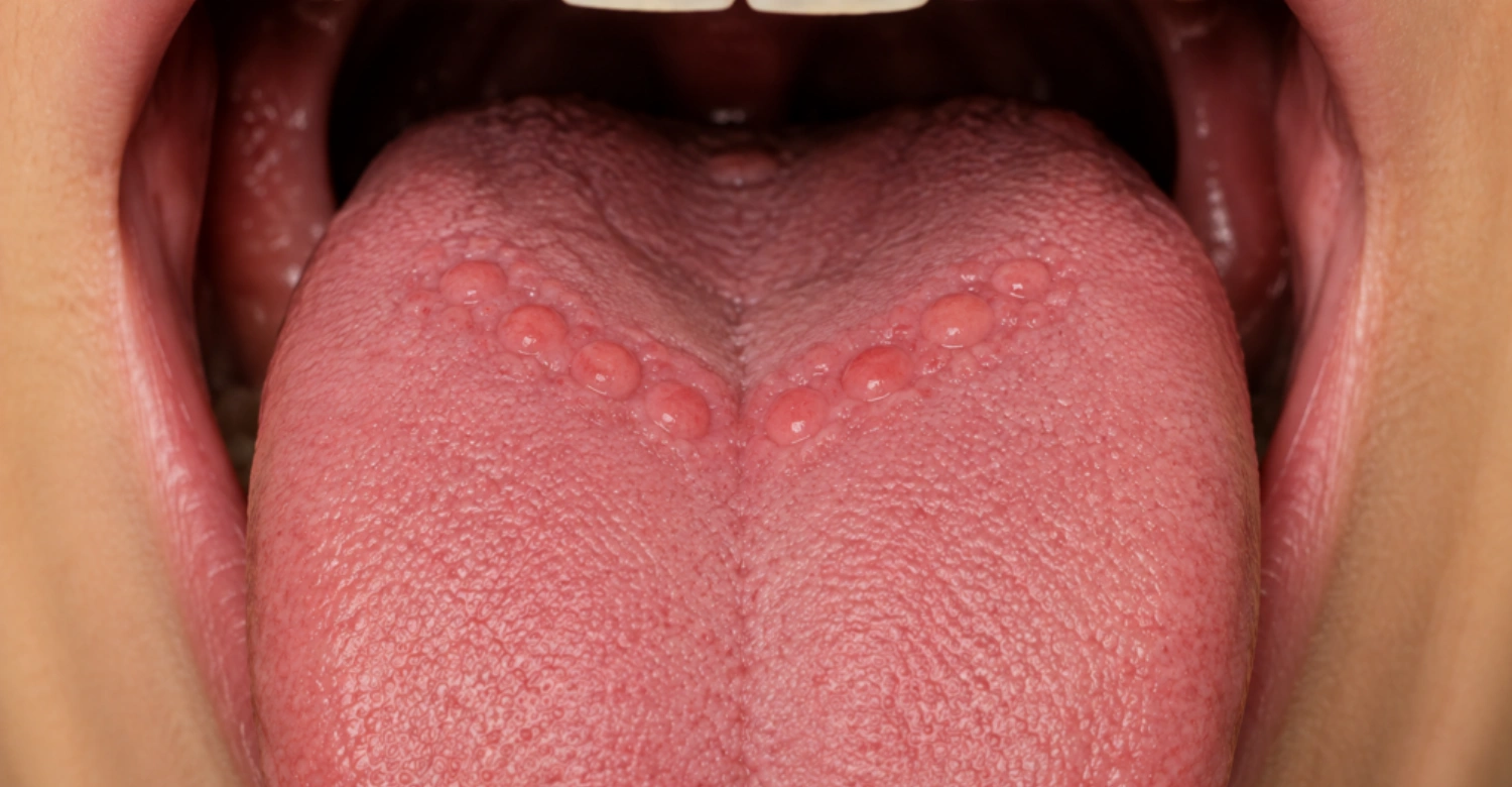 tongue bumps 2